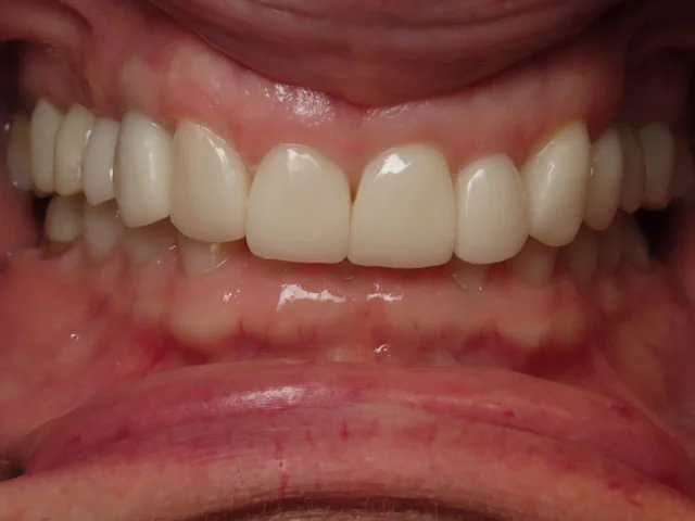 After: CEREC same-day crowns on the upper front teeth.