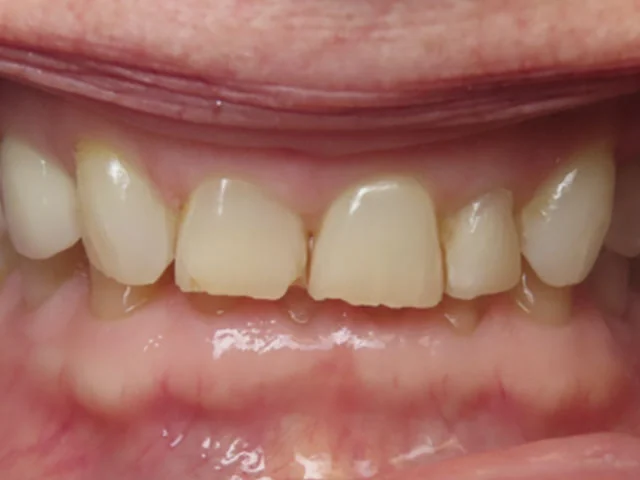 Before: CEREC same-day crowns on the upper front teeth.